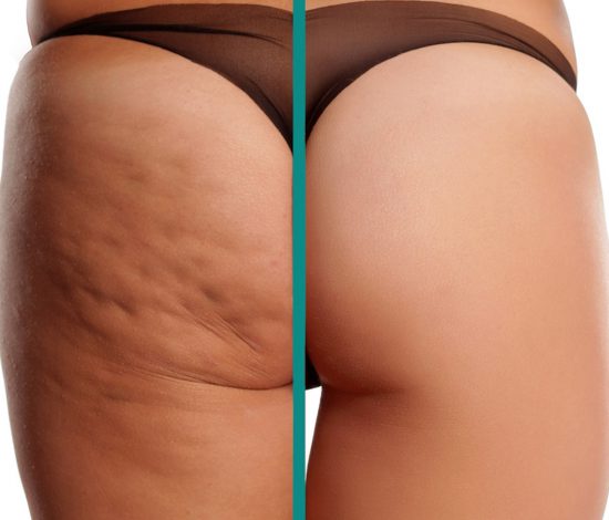 Analisi della Cellulite